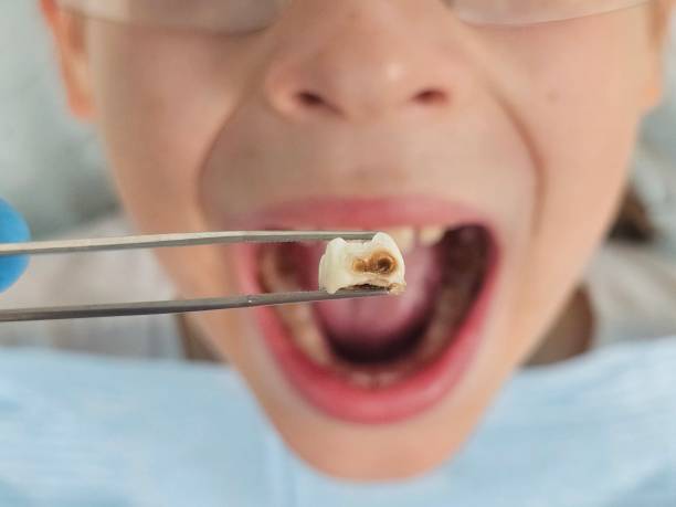 Best Emergency Dental Care for Abscessed Tooth in North Judson, IN